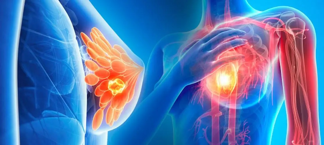 催眠可以帮助控制转移性乳腺癌女性的疼痛